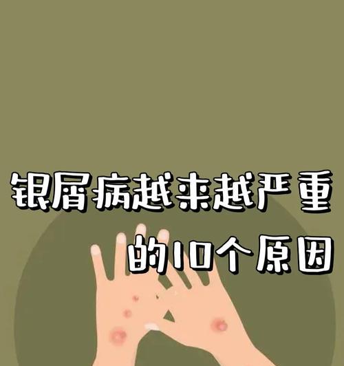 花椒树黄叶病的原因及治疗处理方法（掌握花椒树黄叶病的防治知识，让花椒树健康成长）